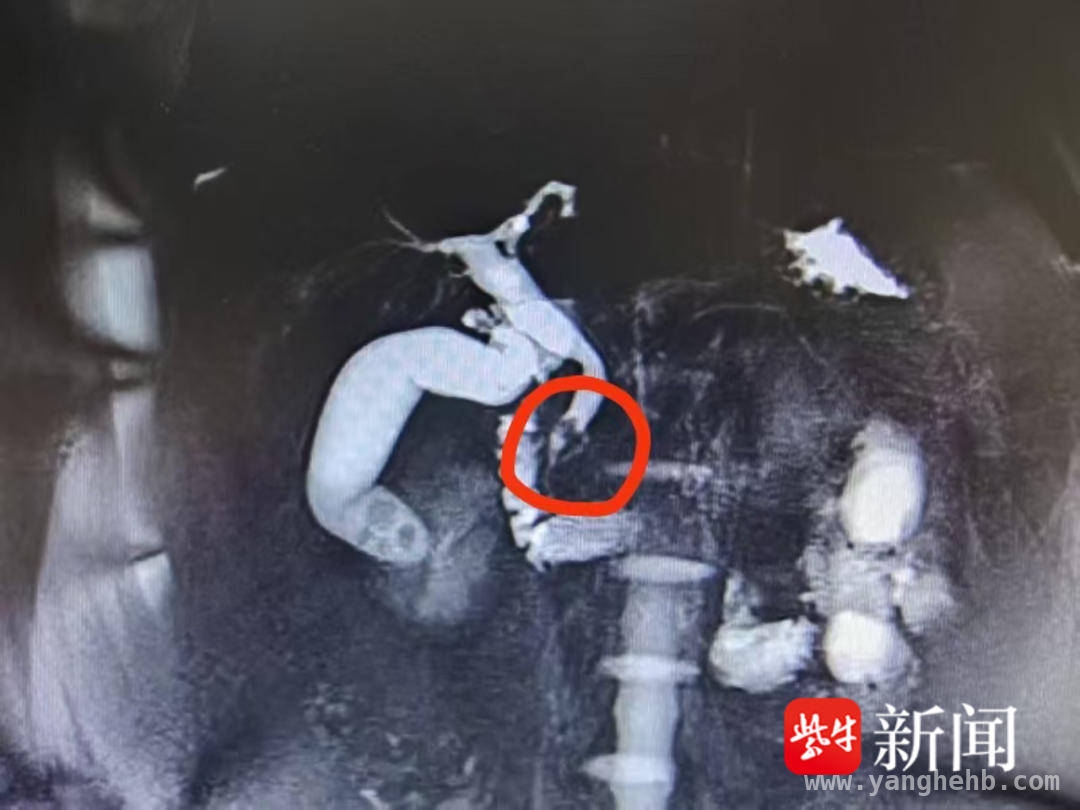 镇江江大附院：用ERCP技术为12岁少年清除胆总管结石隐患，12岁洋洋胆总管结石清除，江大附院无创取石技术获赞