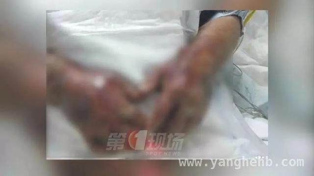 “赶海热”背后：创伤弧菌感染风险大揭秘 小心！处理海鲜不当或引致命危机