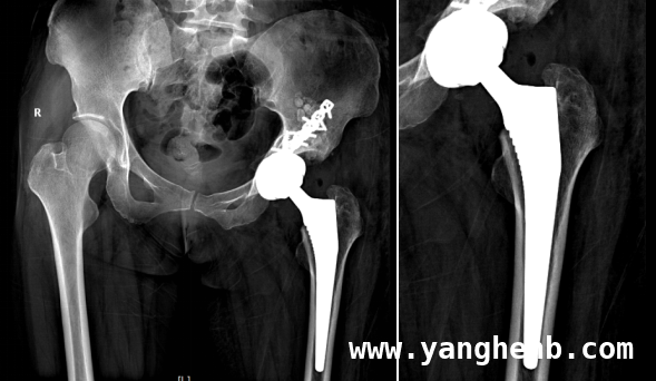 福建医科大学团队完成高难度手术，取出近300颗髋关节软骨瘤 罕见！近300颗软骨瘤从髋关节“现身”