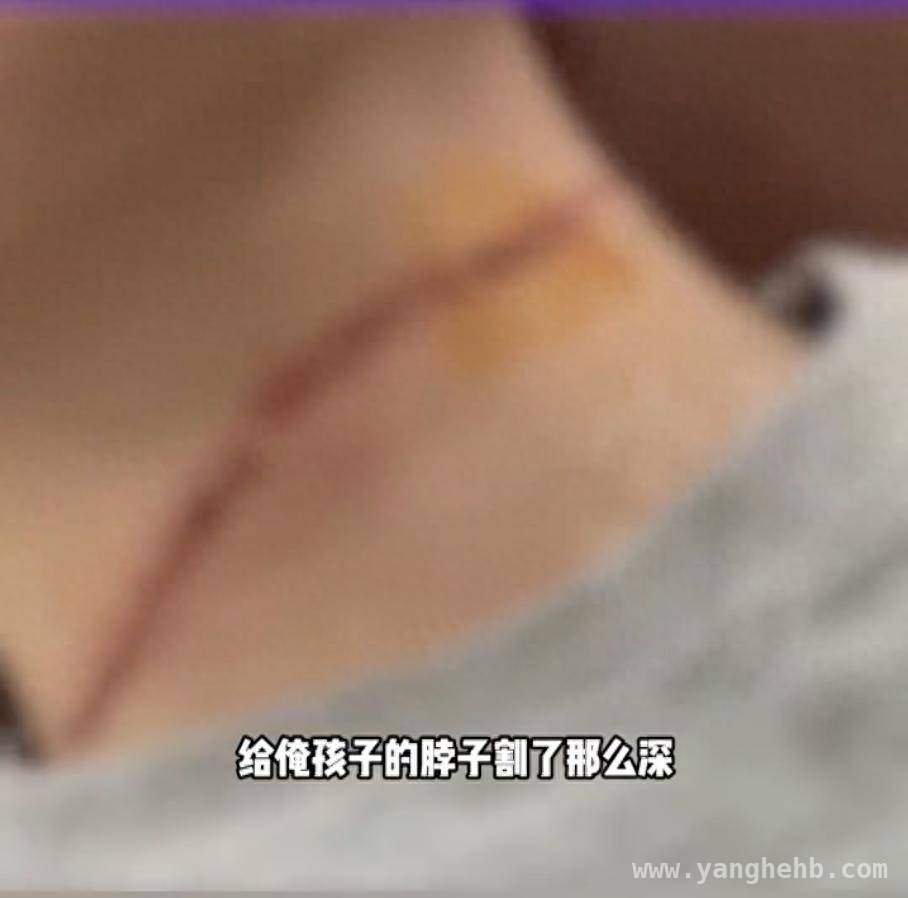春日风筝虽美，“隐形利刃”伤人需警惕