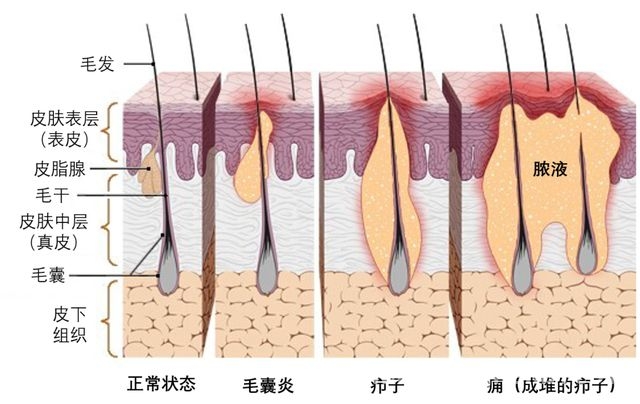 深入了解火疖子：从认识到防治，告别火疖子！科学应对皮肤烦恼