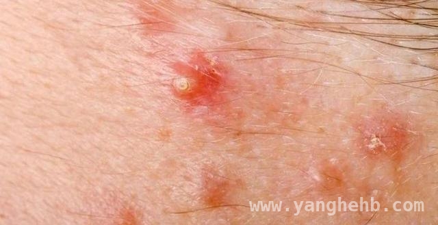 深入了解火疖子：从认识到防治，告别火疖子！科学应对皮肤烦恼